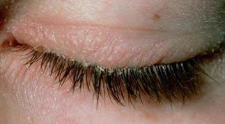 Blepharitis